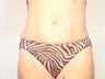 Female Liposuction