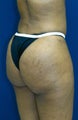 Brazilian Butt Lift