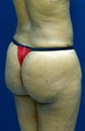 Brazilian Butt Lift
