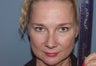 Patient requesting correction for sub-optimal results after esthetic nasal surgery