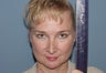 Patient requesting correction for sub-optimal results after esthetic nasal surgery