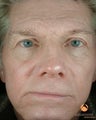 Male Patient Treated with BOTOX® Cosmetic, Perlane® & Sculptra®
