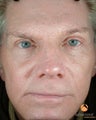 Male Patient Treated with BOTOX® Cosmetic, Perlane® & Sculptra®