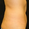 CoolSculpting
