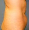 CoolSculpting