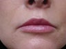 Fat transfer for lip augmentation
