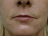 Fat transfer for lip augmentation