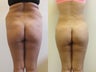 Brazilian Butt Lift