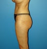 liposuction body/buttocks