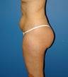 liposuction body/buttocks