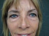 Female underwent upper and lower eyelidplasty under local