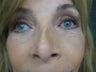 Female underwent upper and lower eyelidplasty under local