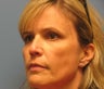 Woman in 40s treated for wrinkles
