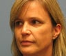 Woman in 40s treated for wrinkles