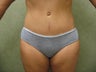 Tummy Tuck Revision