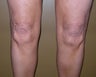 58 Year Old Female Treated For Knee Fullness