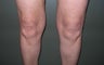 58 Year Old Female Treated For Knee Fullness