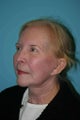 75 Year Old Patient Treated for Facial Rejuvenation