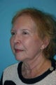 75 Year Old Patient Treated for Facial Rejuvenation