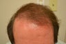 63 year old Male treated with Hair Transplantation