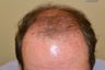 63 year old Male treated with Hair Transplantation