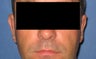 34 Year Old Male Otoplasty