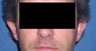 34 Year Old Male Otoplasty