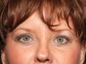 Quad Eyelid Lift