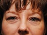 Quad Eyelid Lift
