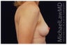 Breast Lift