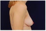 Breast Lift