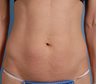 truSculpt