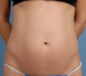 truSculpt