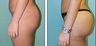 Brazilian Butt Lift Before & After