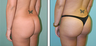 Brazilian Butt Lift Before & After