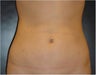 SmartLipo MPX