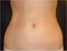 SmartLipo MPX