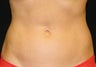 CoolSculpting