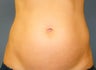 CoolSculpting
