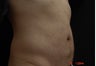 Coolsculpting Male Abdomen