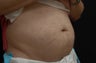 Coolsculpting Male Abdomen