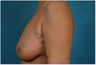 Breast reconstruction - Flap-based
