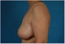 Breast reconstruction - Flap-based