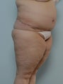Body Lift