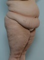 Body Lift