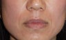 Soft Tissue Fillers Patient