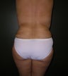 Liposuction of the Back and Posterior Flanks