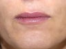 40 Year Old Female with Juvederm for Lips