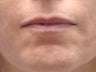 40 Year Old Female with Juvederm for Lips