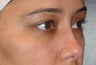 Restylane